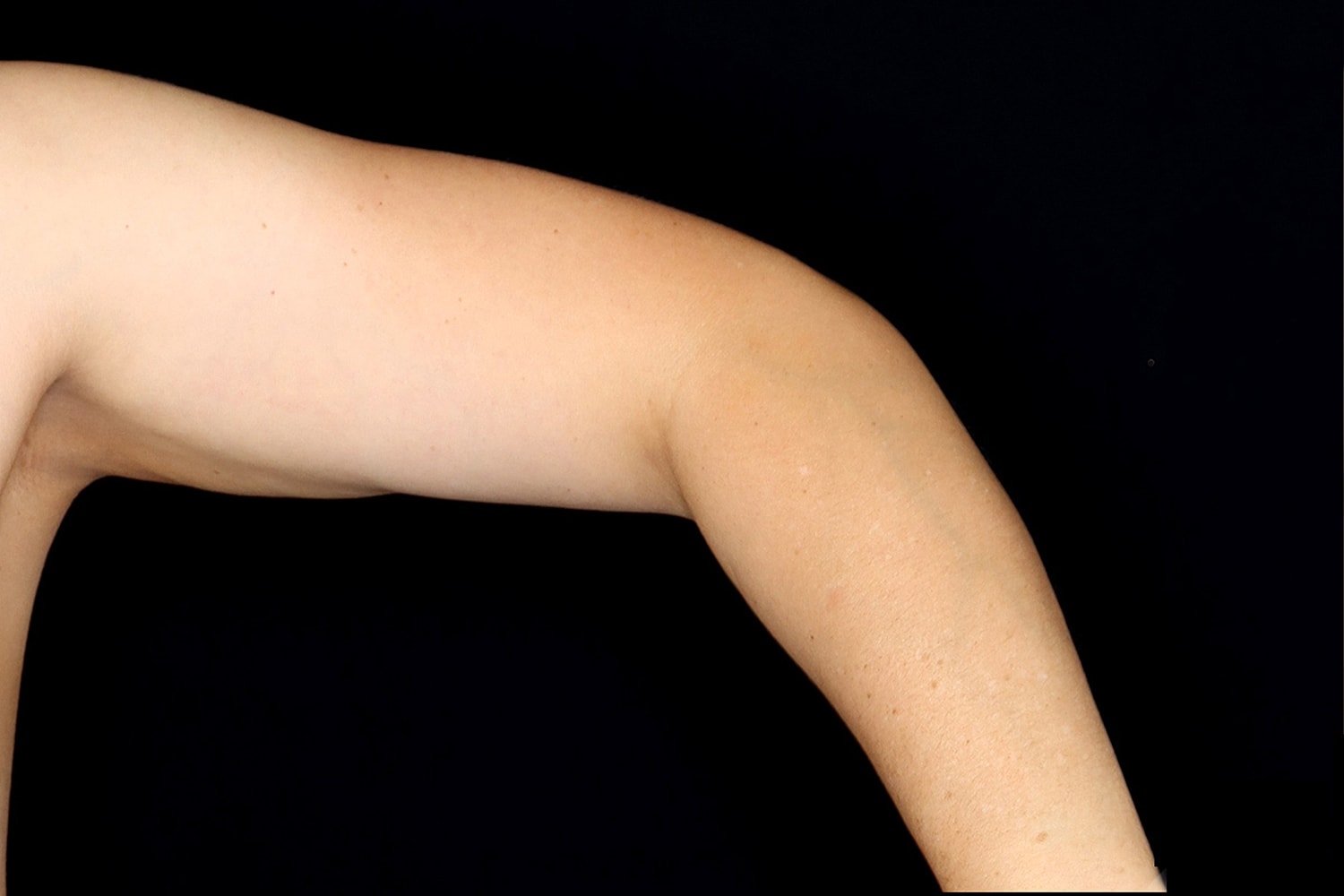 Brachioplasty | Arm Lift Before & After