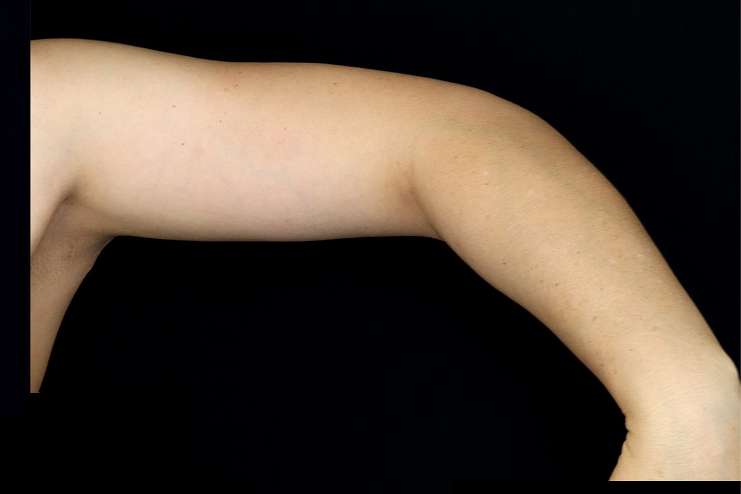 Brachioplasty | Arm Lift Before & After