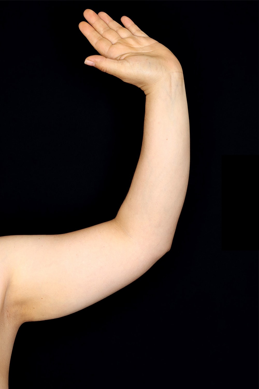 Brachioplasty | Arm Lift Before & After