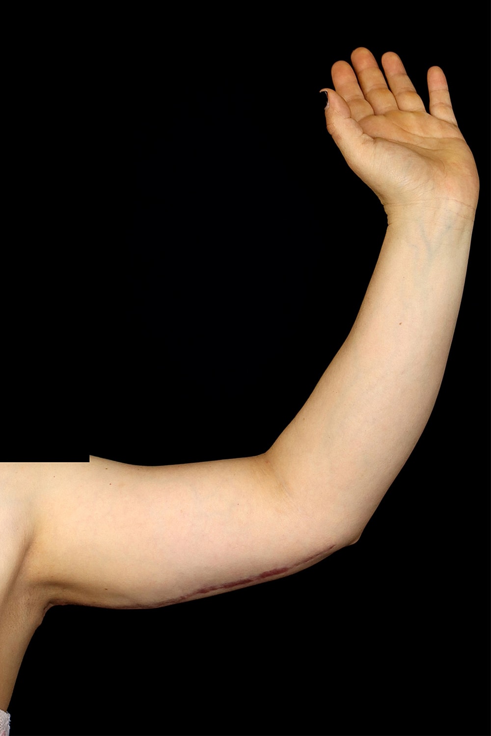 Brachioplasty | Arm Lift Before & After