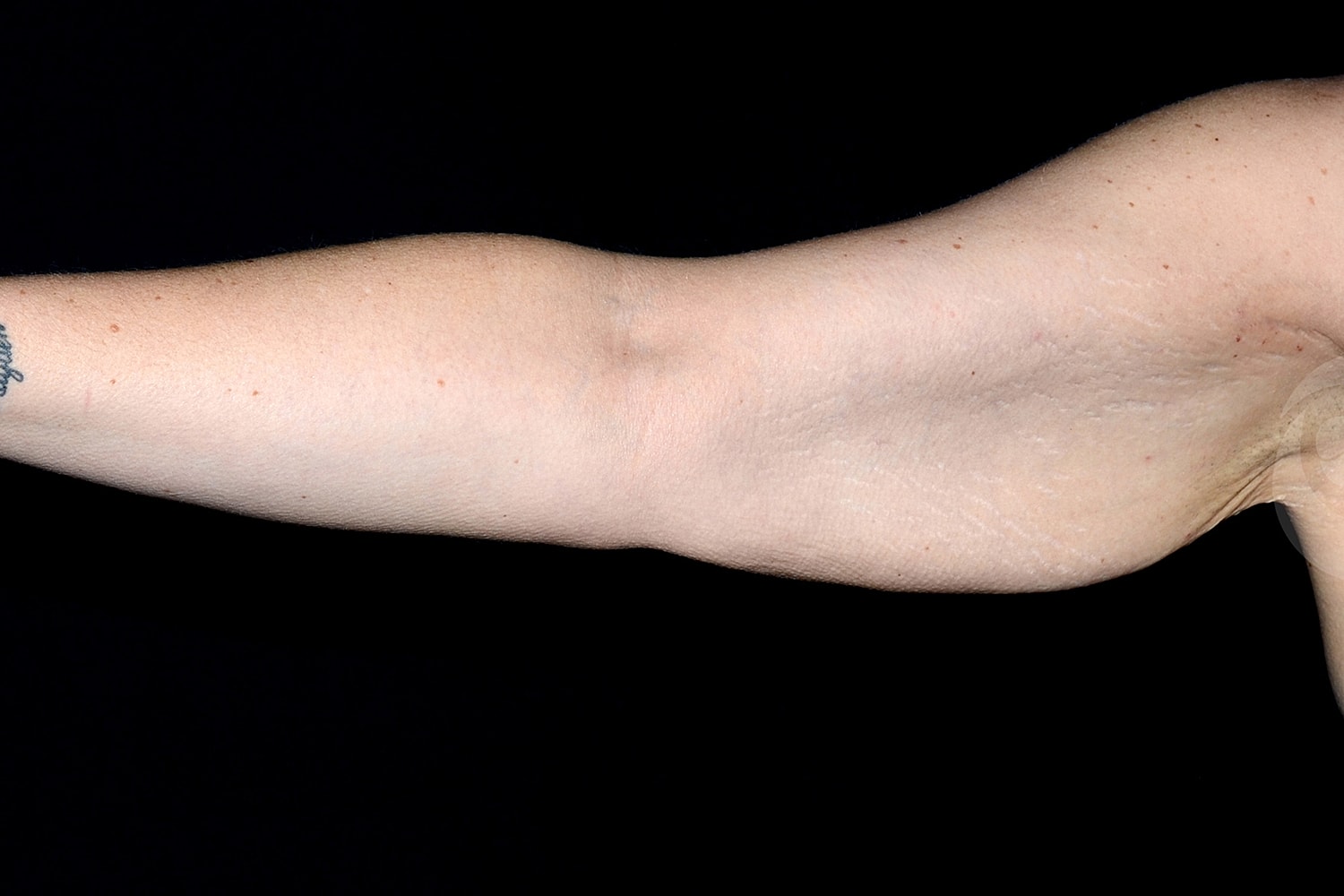 Brachioplasty | Arm Lift Before & After