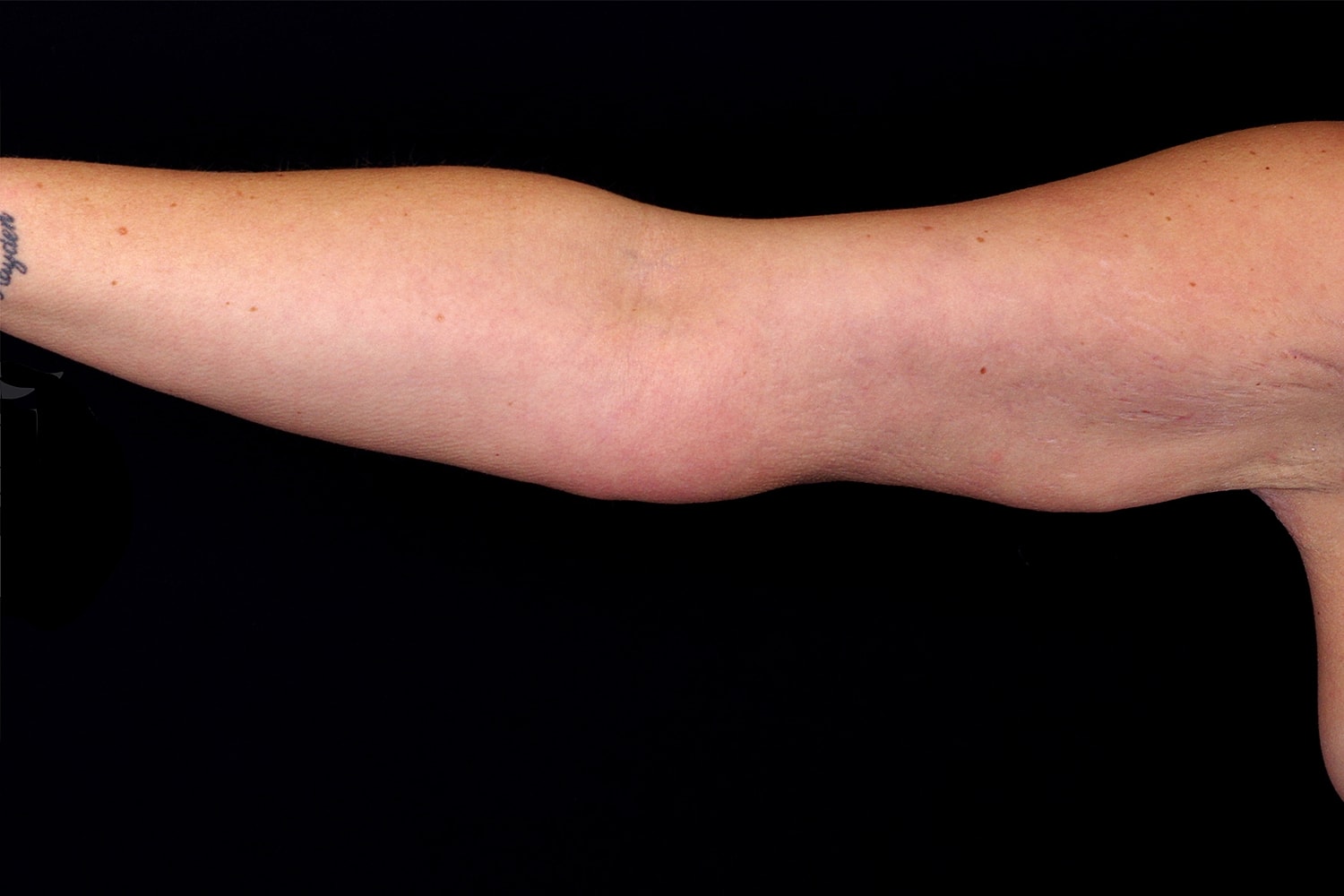 Brachioplasty | Arm Lift Before & After