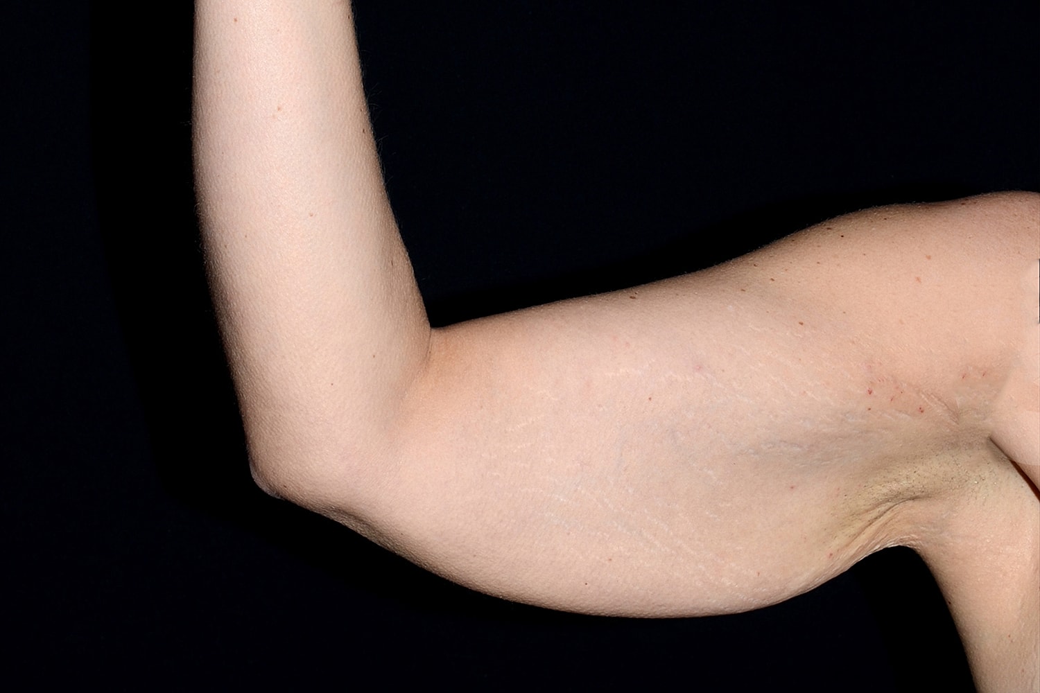 Brachioplasty | Arm Lift Before & After