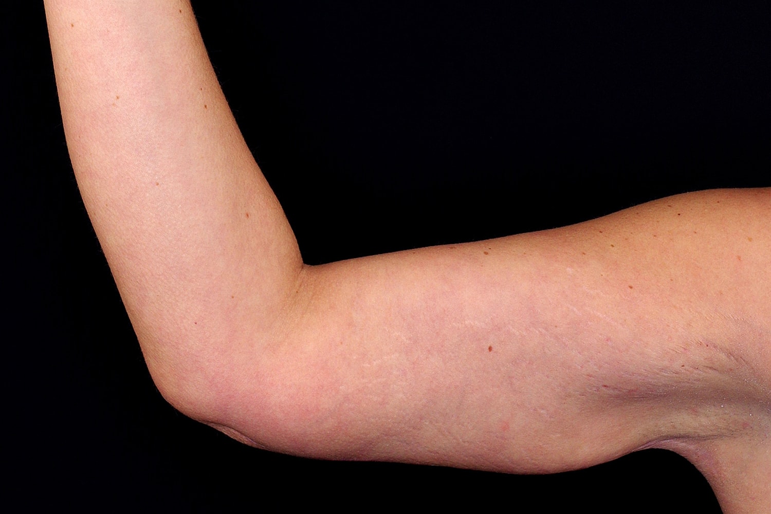 Brachioplasty | Arm Lift Before & After