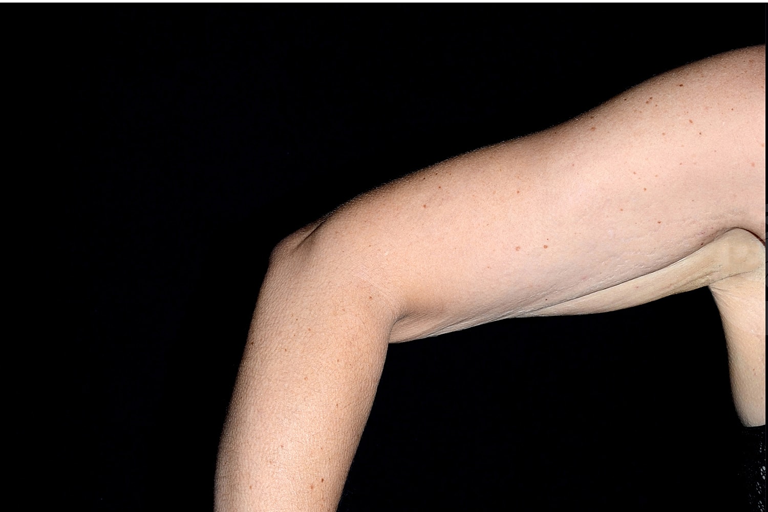 Brachioplasty | Arm Lift Before & After