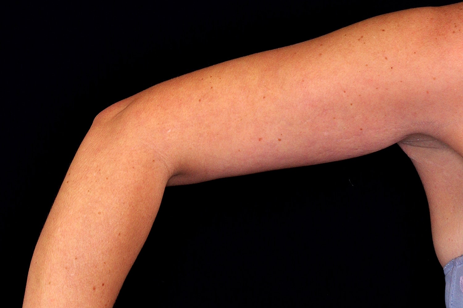 Brachioplasty | Arm Lift Before & After