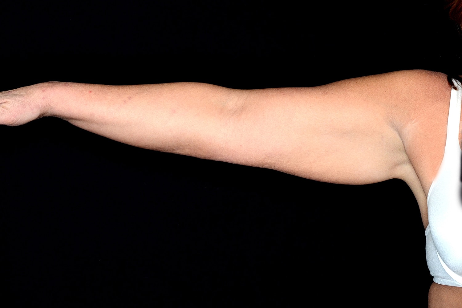 Brachioplasty | Arm Lift Before & After