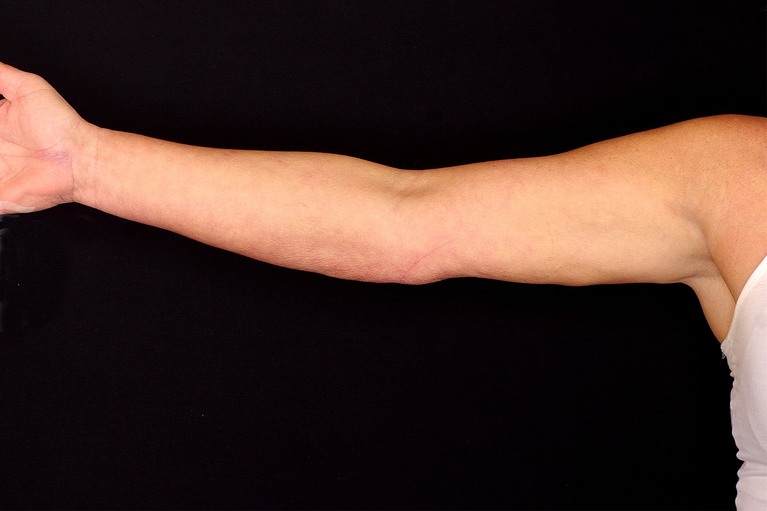 Brachioplasty | Arm Lift Before & After
