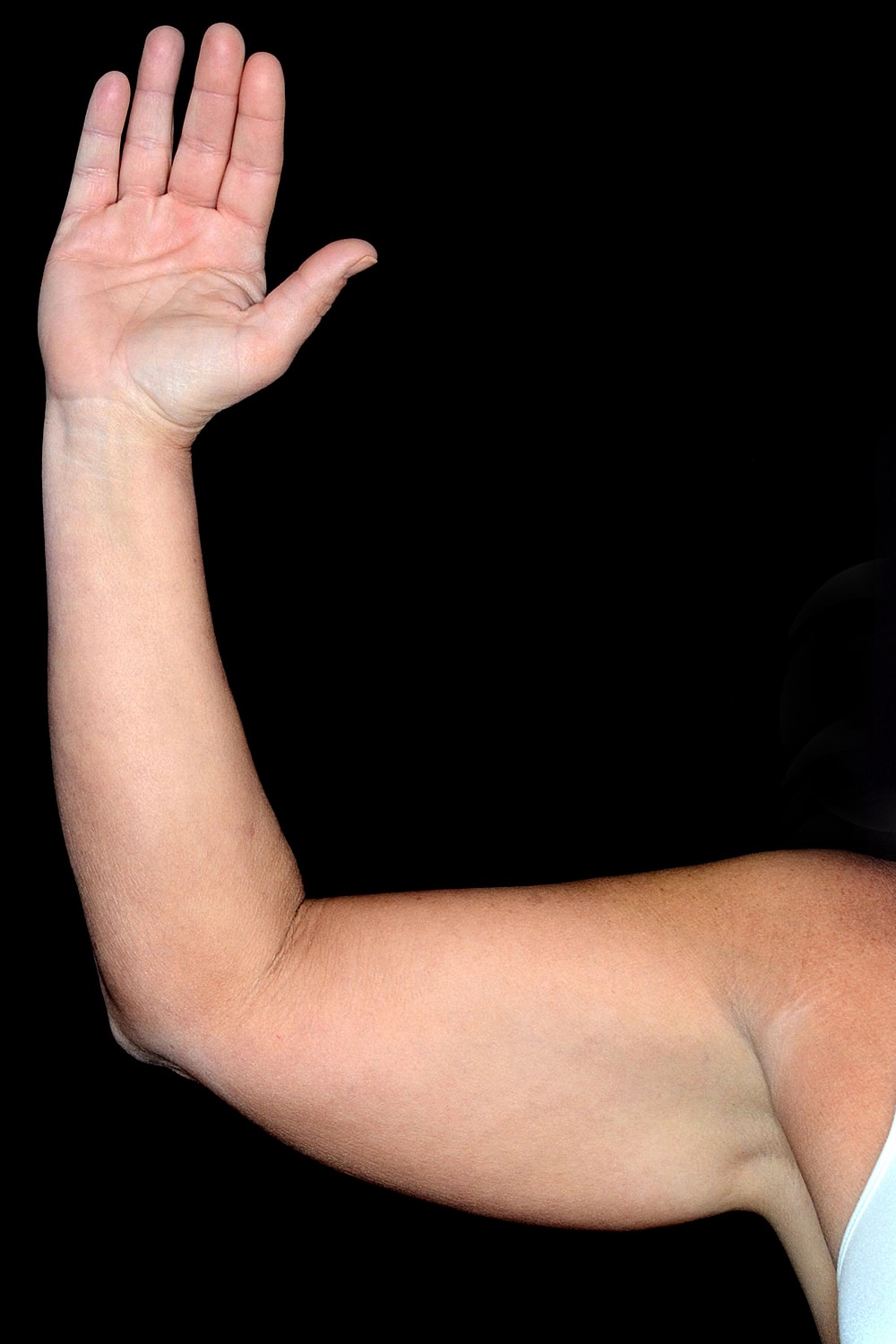 Brachioplasty | Arm Lift Before & After