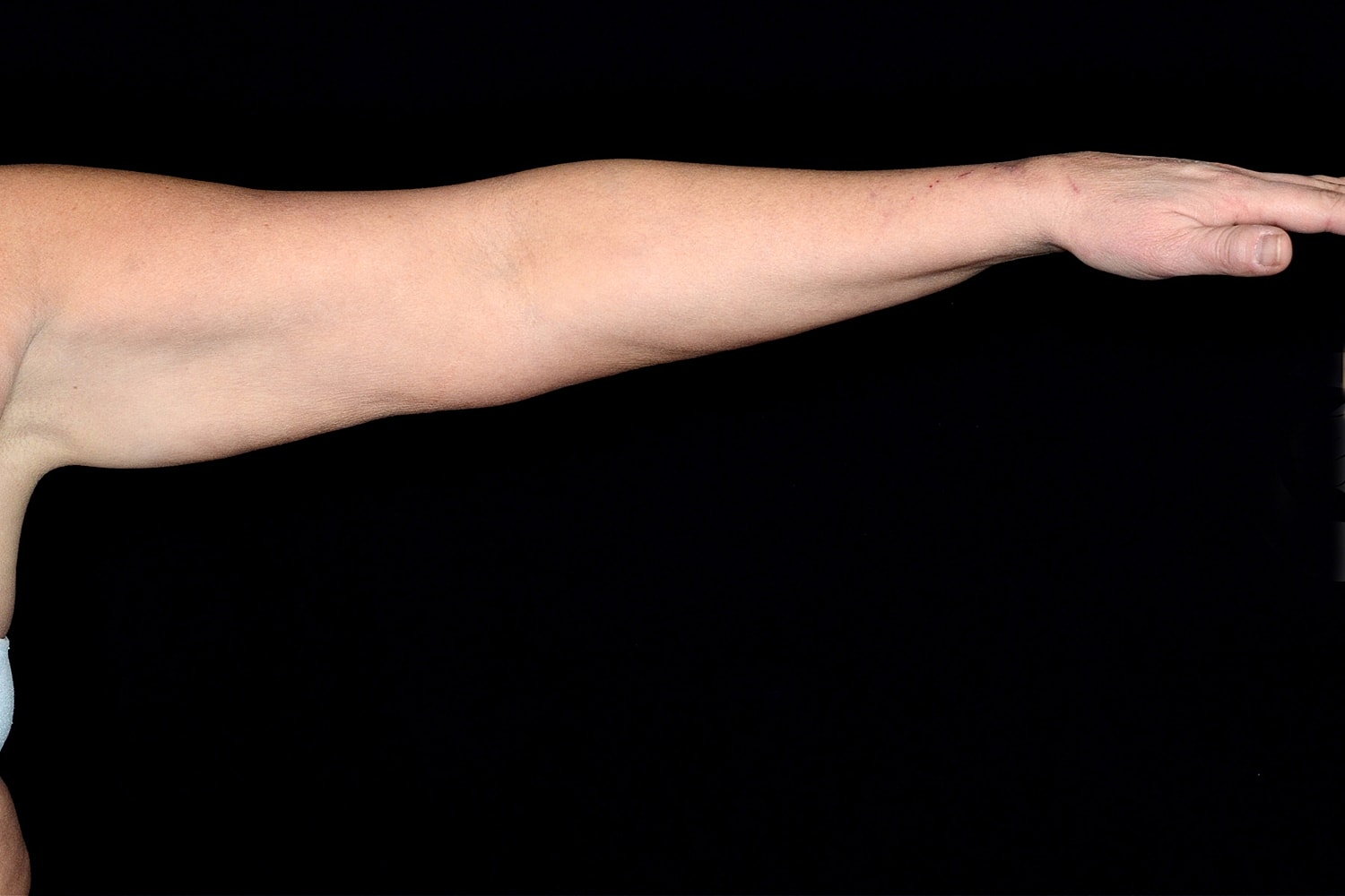 Brachioplasty | Arm Lift Before & After