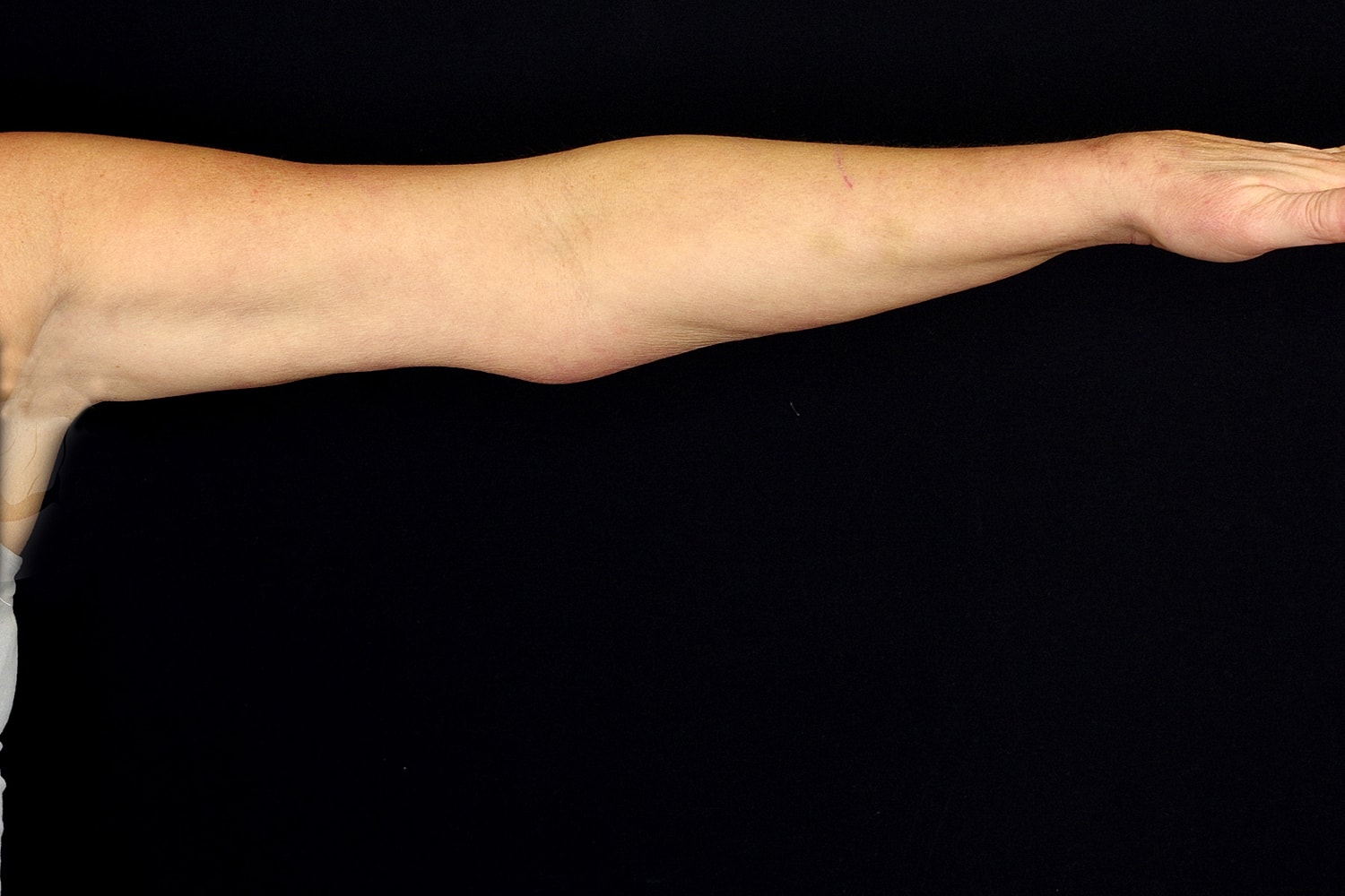Brachioplasty | Arm Lift Before & After