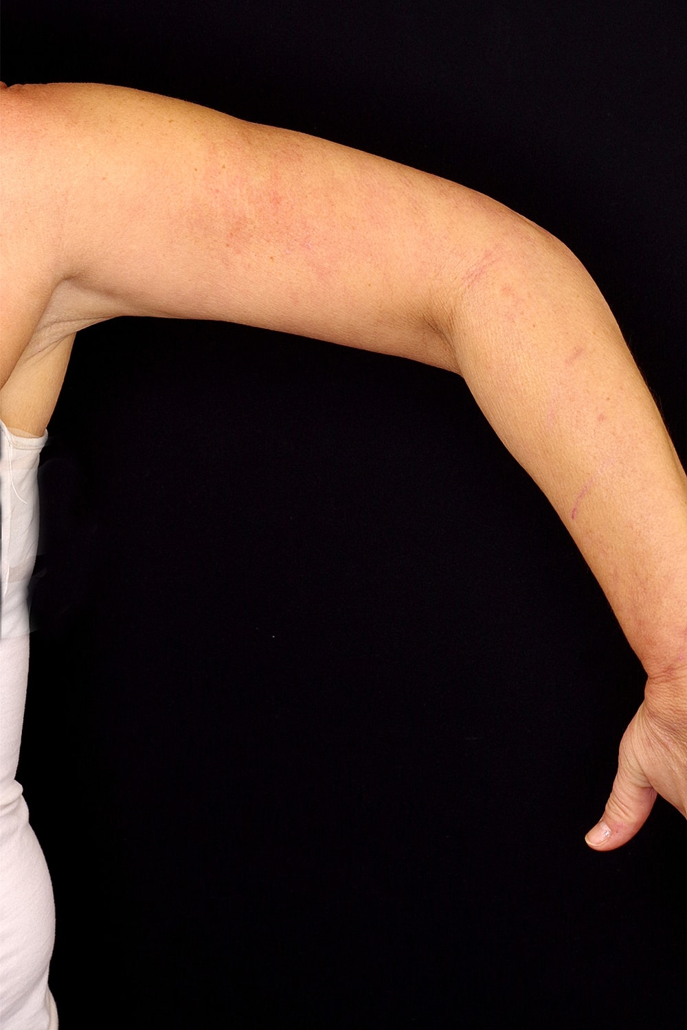 Brachioplasty | Arm Lift Before & After