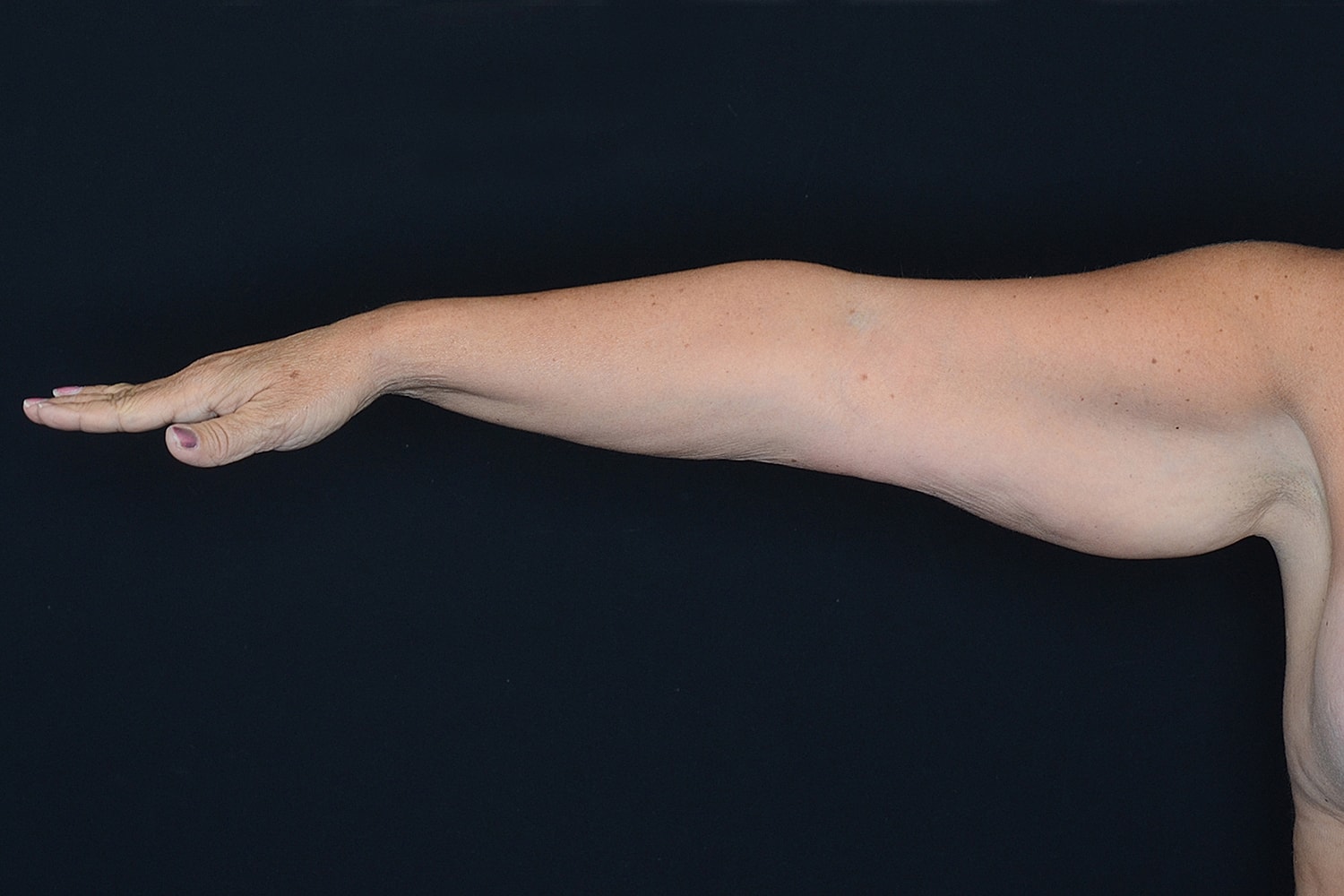 Brachioplasty | Arm Lift Before & After