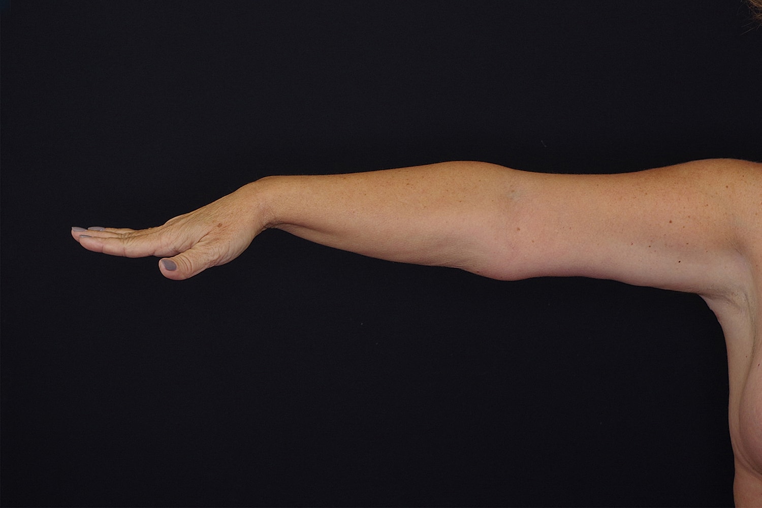 Brachioplasty | Arm Lift Before & After