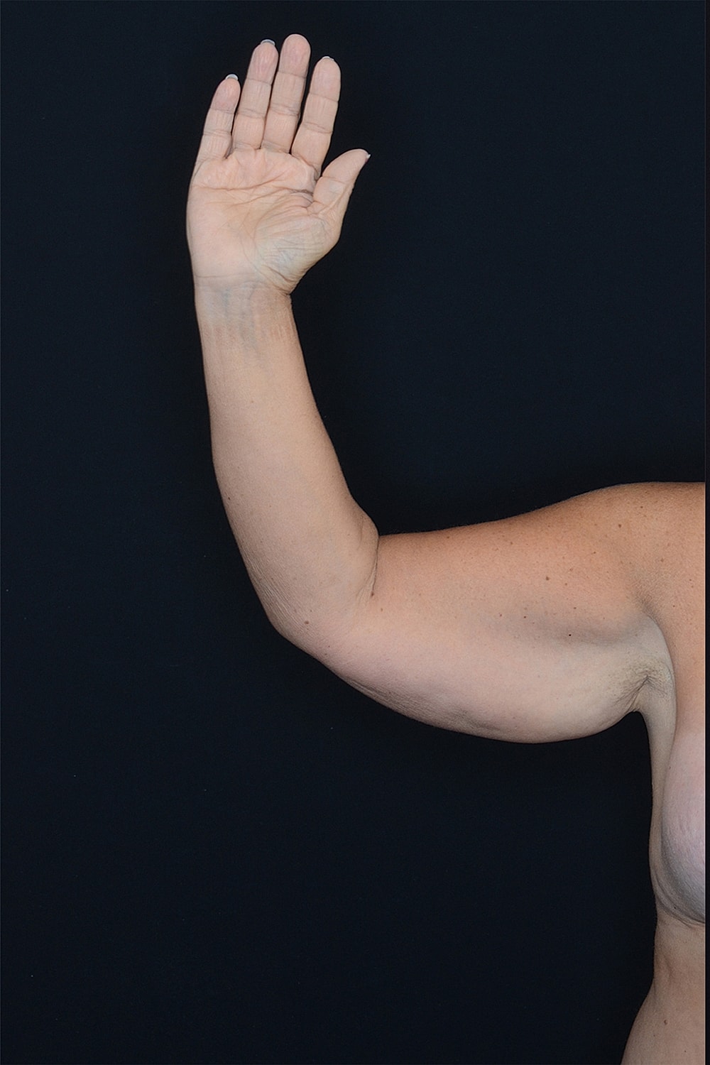Brachioplasty | Arm Lift Before & After