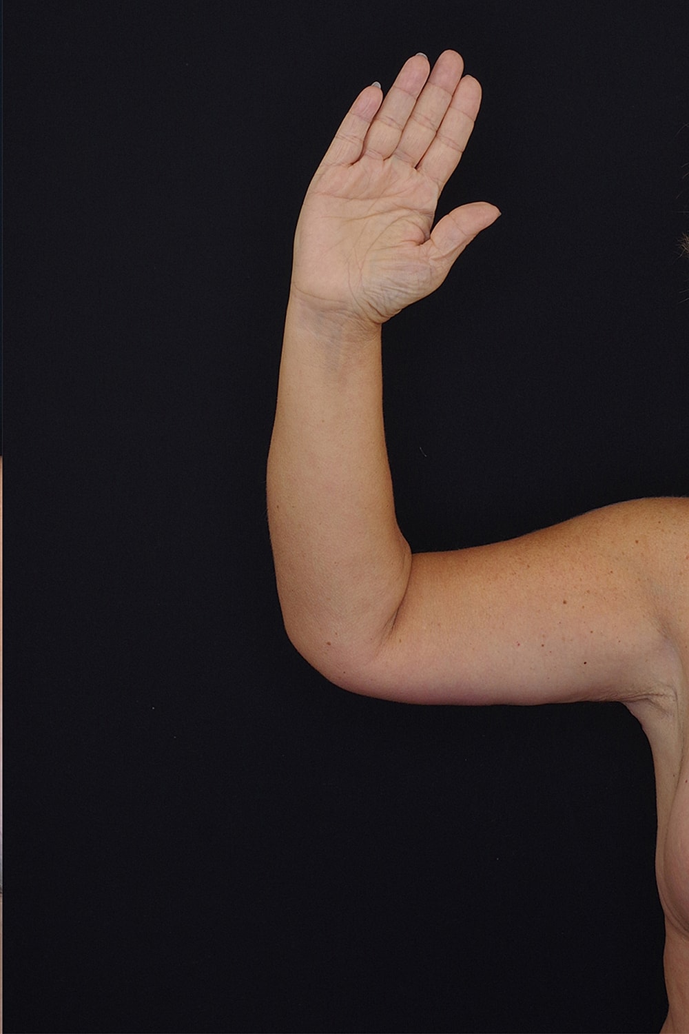 Brachioplasty | Arm Lift Before & After