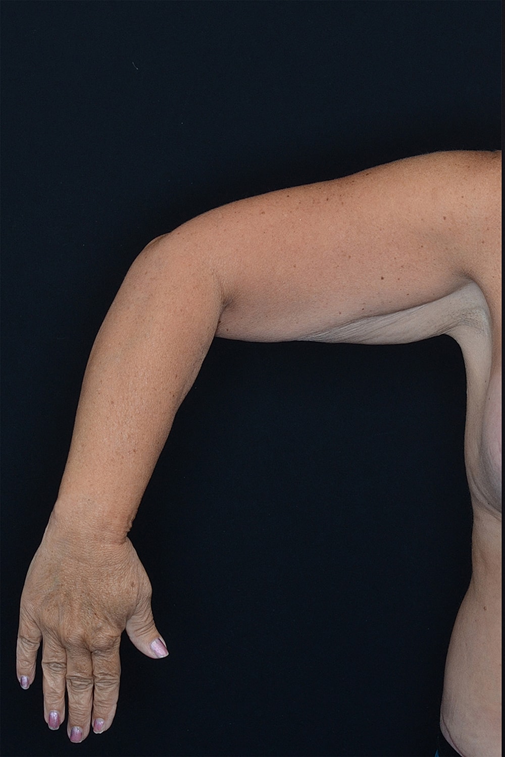 Brachioplasty | Arm Lift Before & After