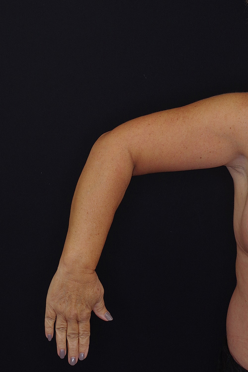 Brachioplasty | Arm Lift Before & After