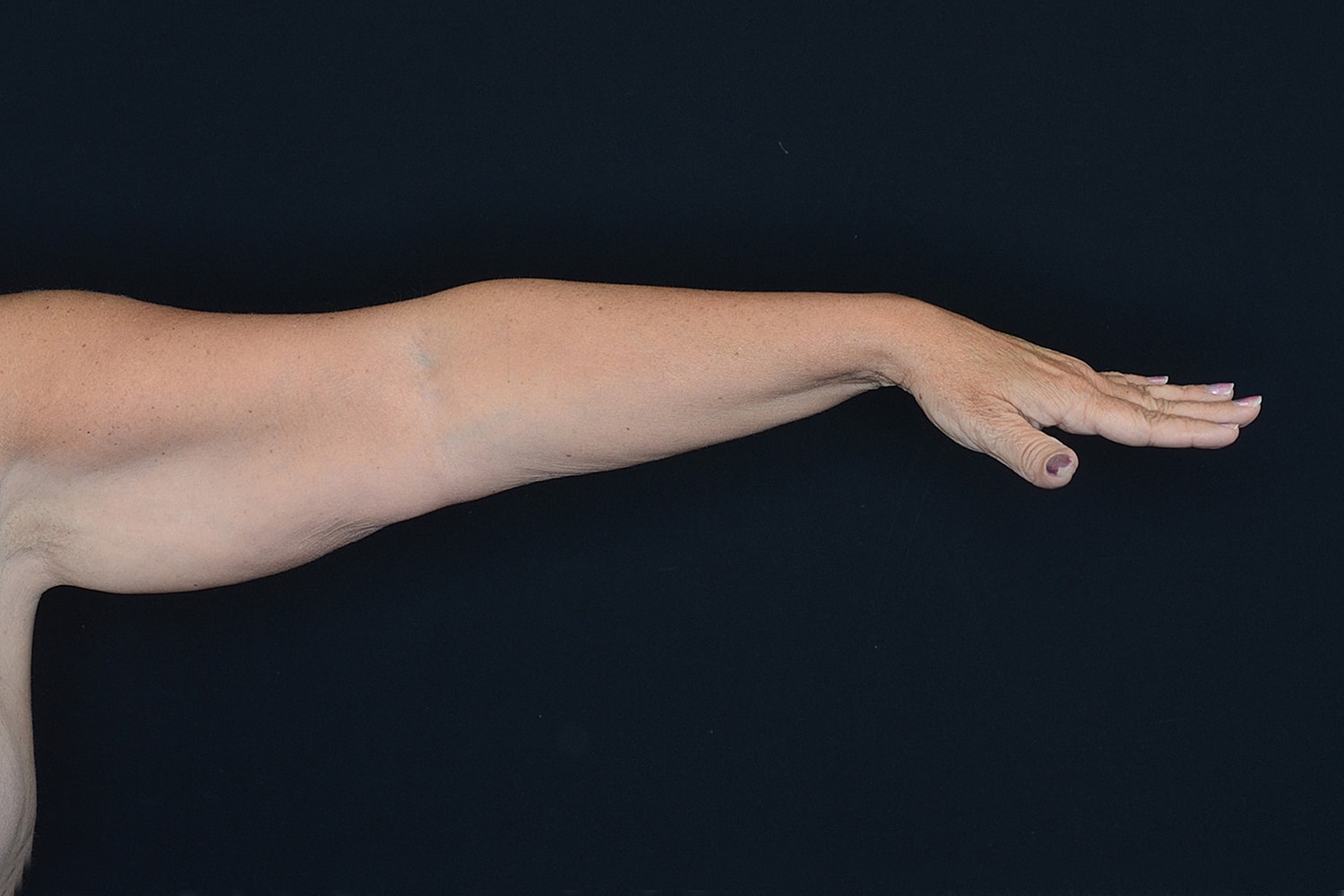 Brachioplasty | Arm Lift Before & After
