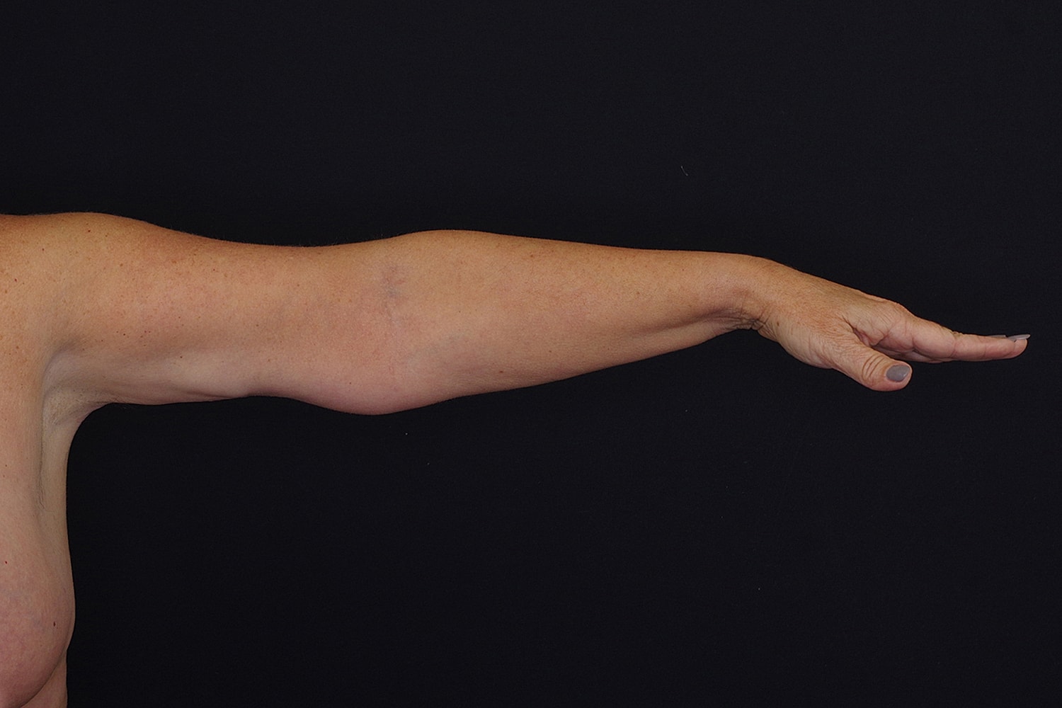 Brachioplasty | Arm Lift Before & After