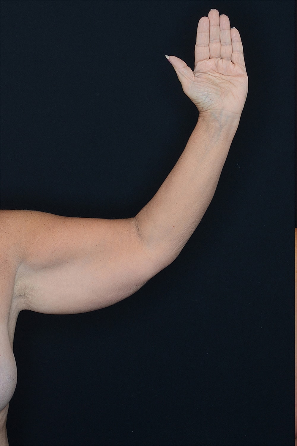 Brachioplasty | Arm Lift Before & After