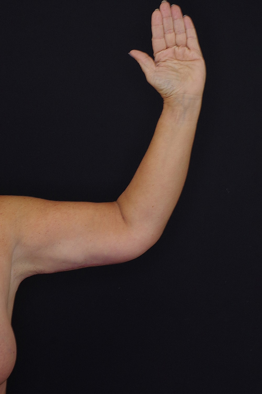 Brachioplasty | Arm Lift Before & After