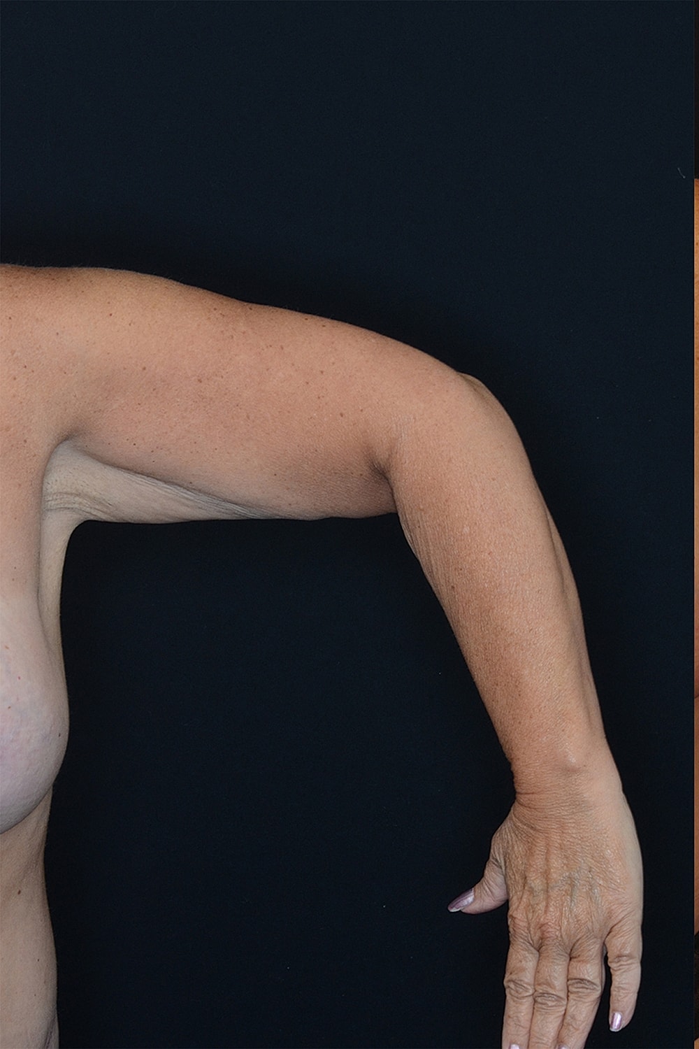 Brachioplasty | Arm Lift Before & After