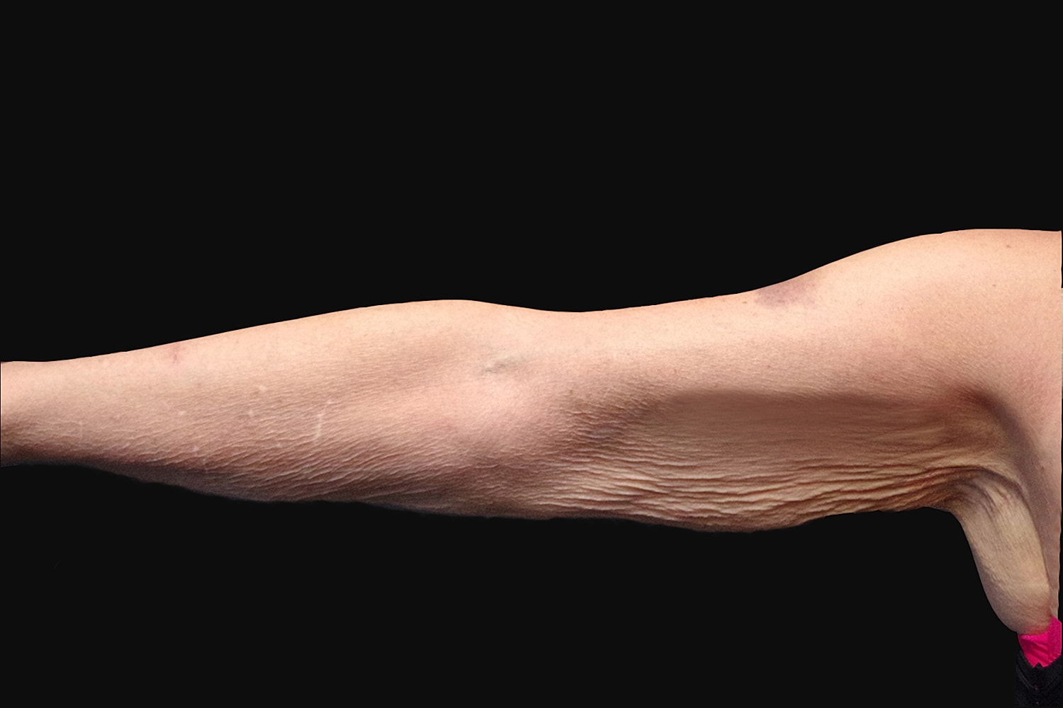 Brachioplasty | Arm Lift Before & After