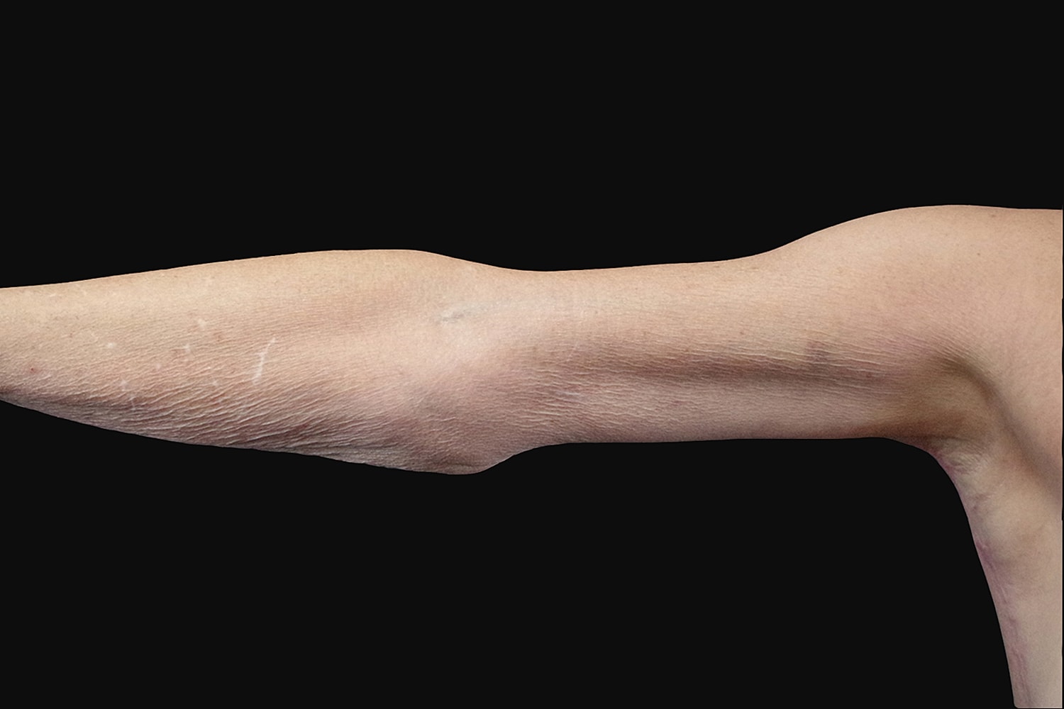 Brachioplasty | Arm Lift Before & After