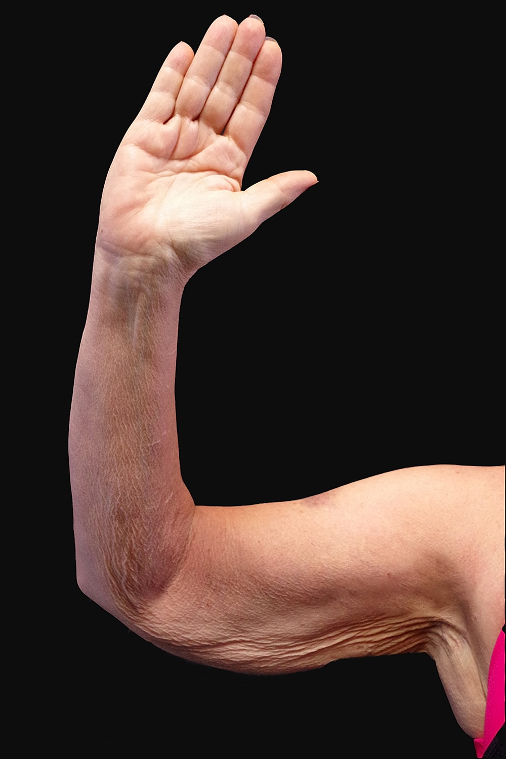 Brachioplasty | Arm Lift Before & After