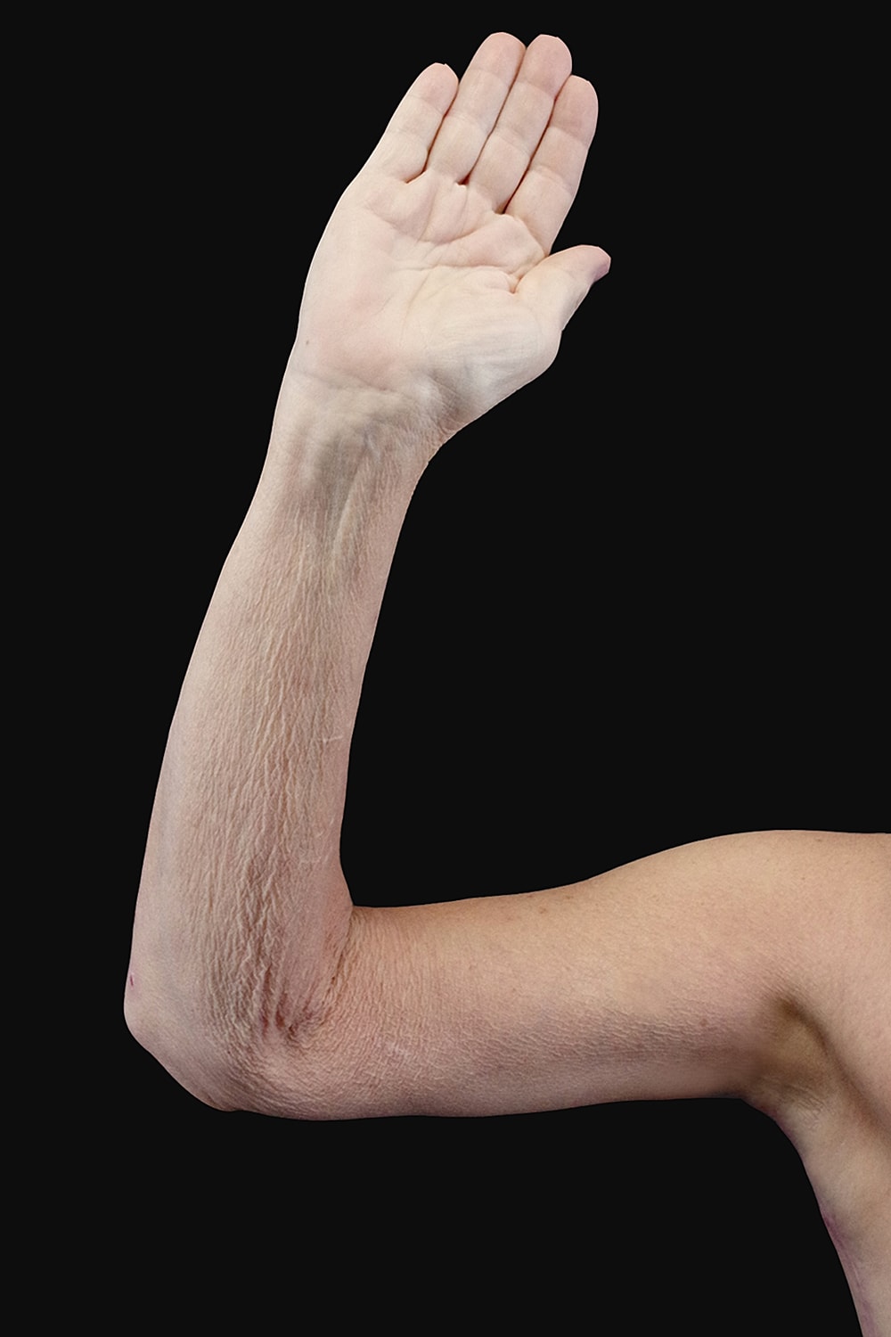 Brachioplasty | Arm Lift Before & After