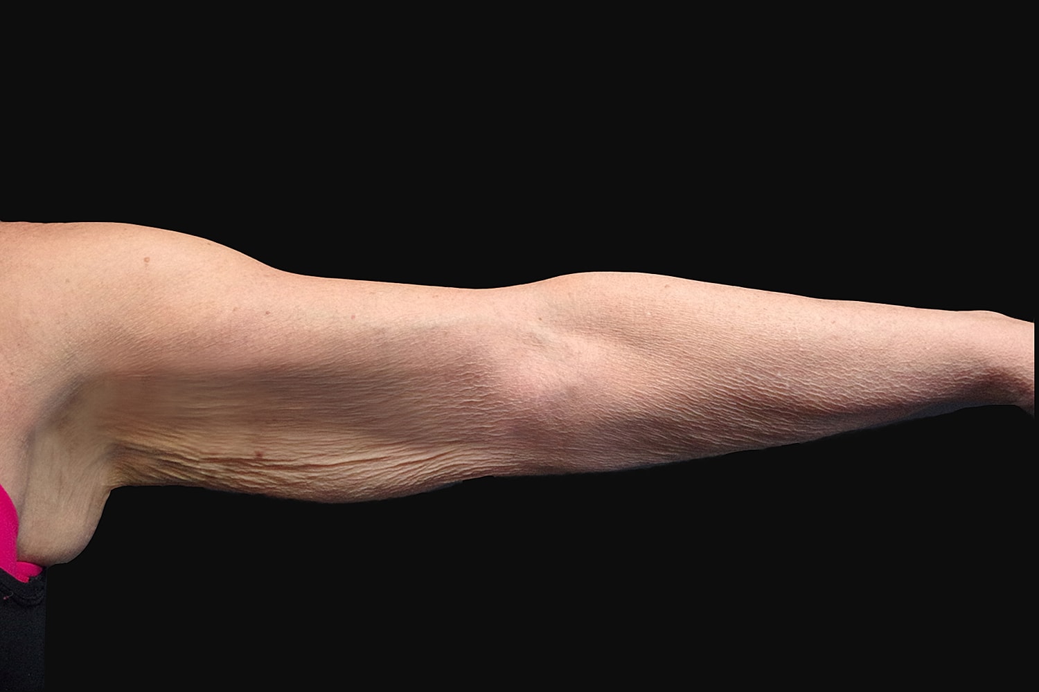 Brachioplasty | Arm Lift Before & After