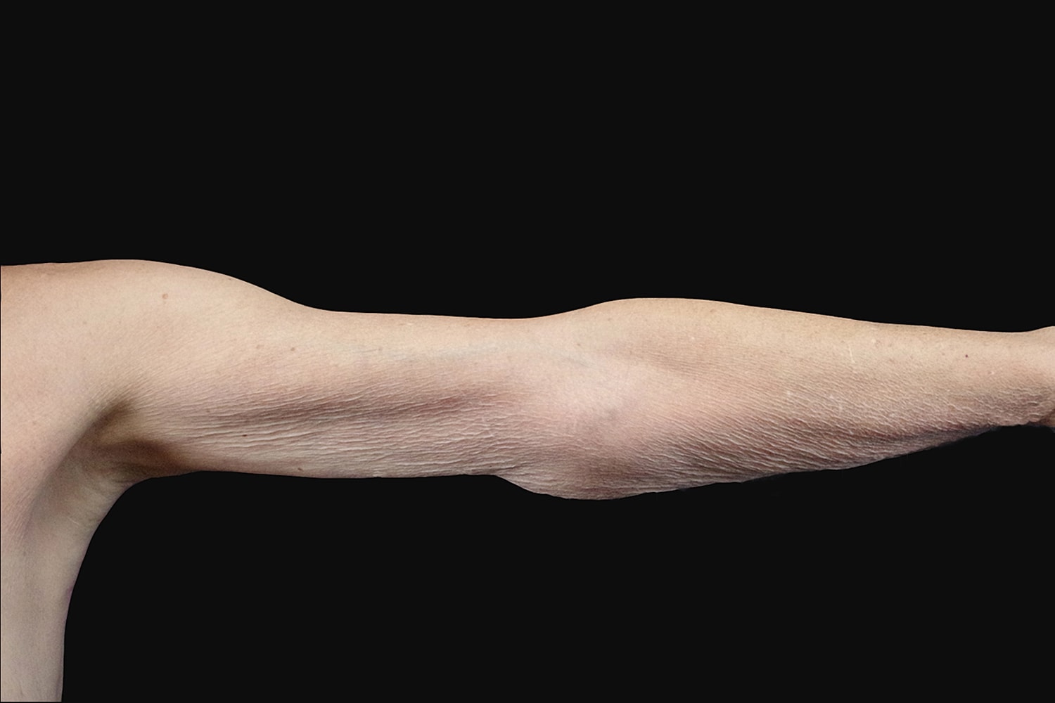 Brachioplasty | Arm Lift Before & After