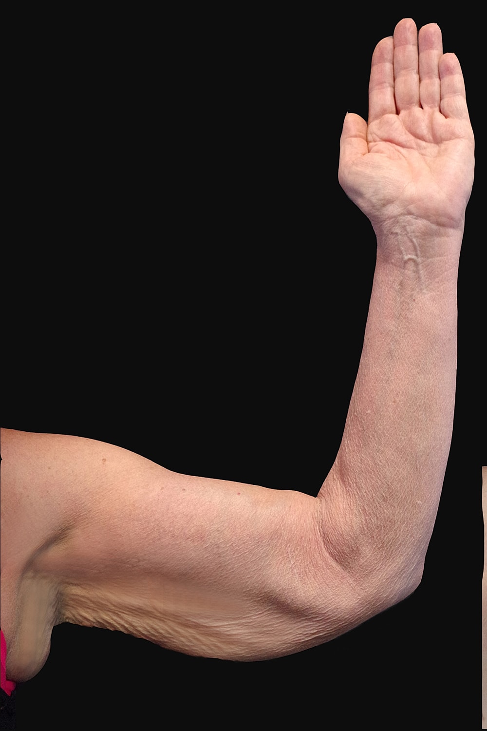 Brachioplasty | Arm Lift Before & After