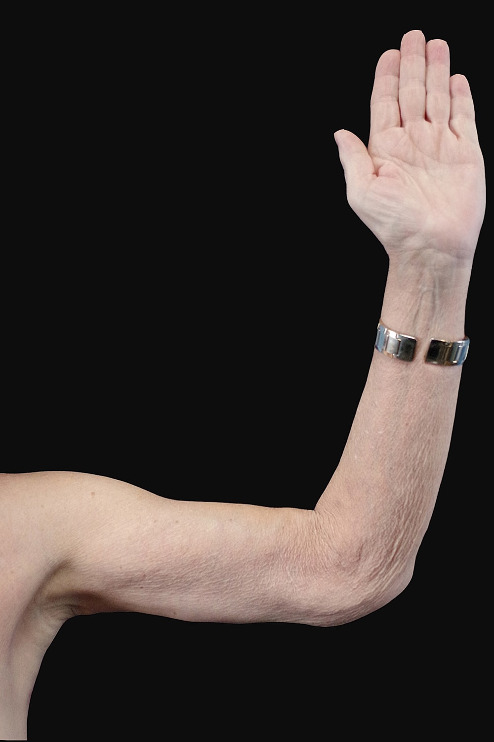 Brachioplasty | Arm Lift Before & After