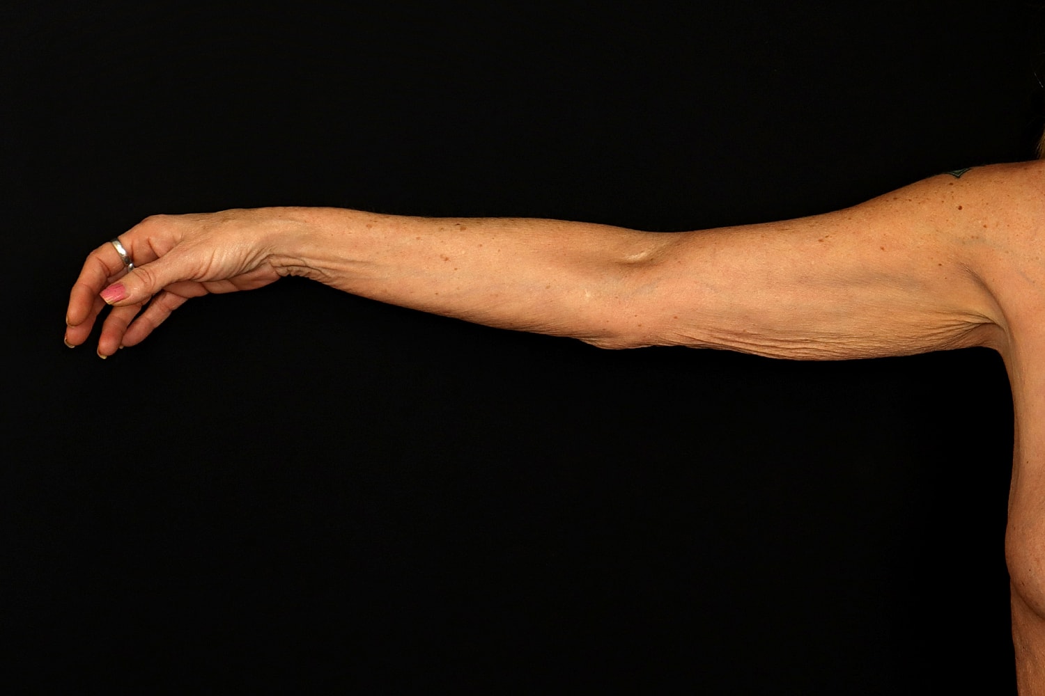 Brachioplasty | Arm Lift Before & After
