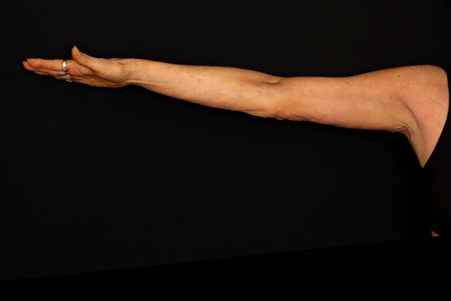 Brachioplasty | Arm Lift Before & After