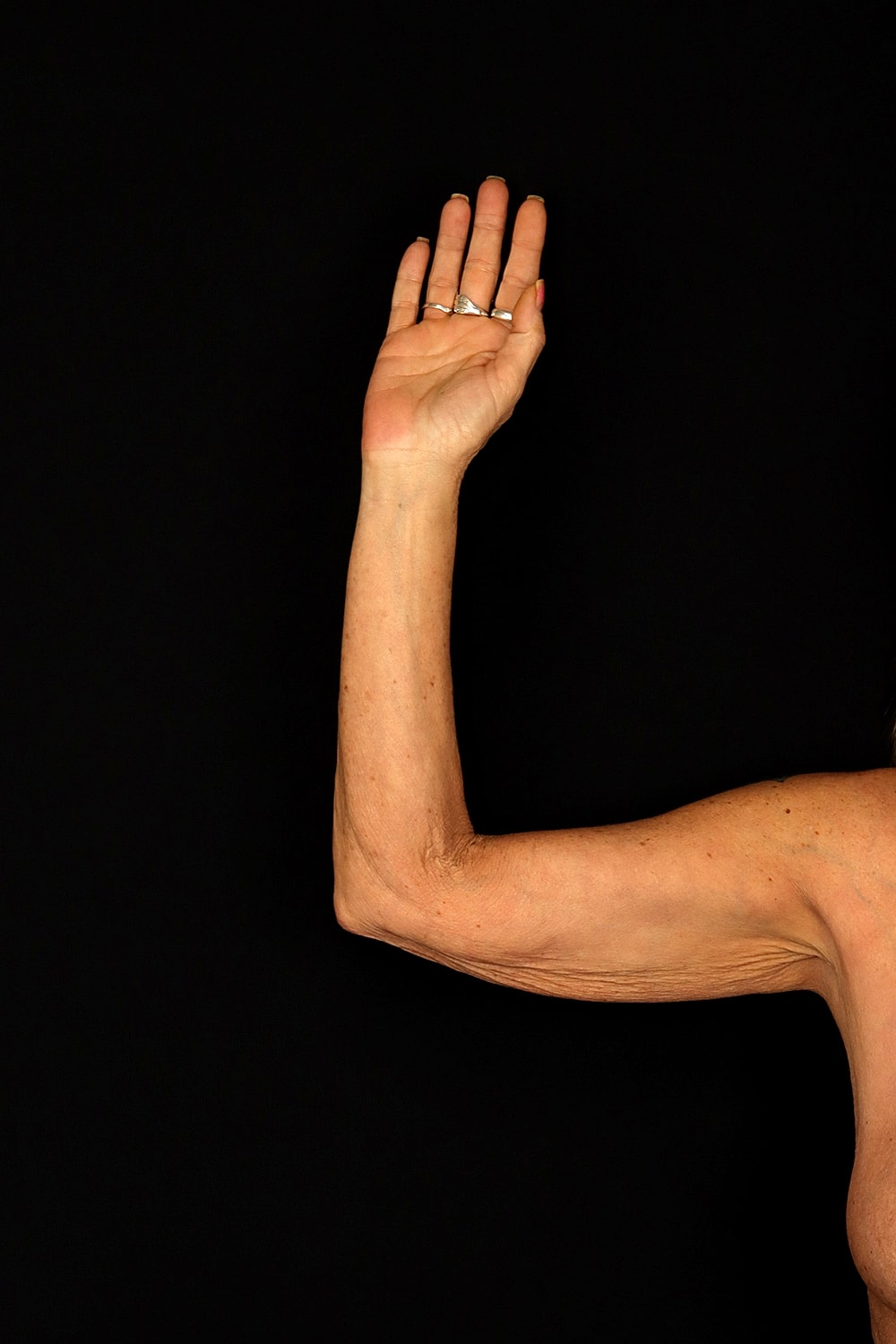 Brachioplasty | Arm Lift Before & After