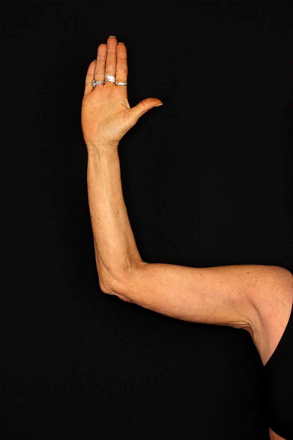 Brachioplasty | Arm Lift Before & After