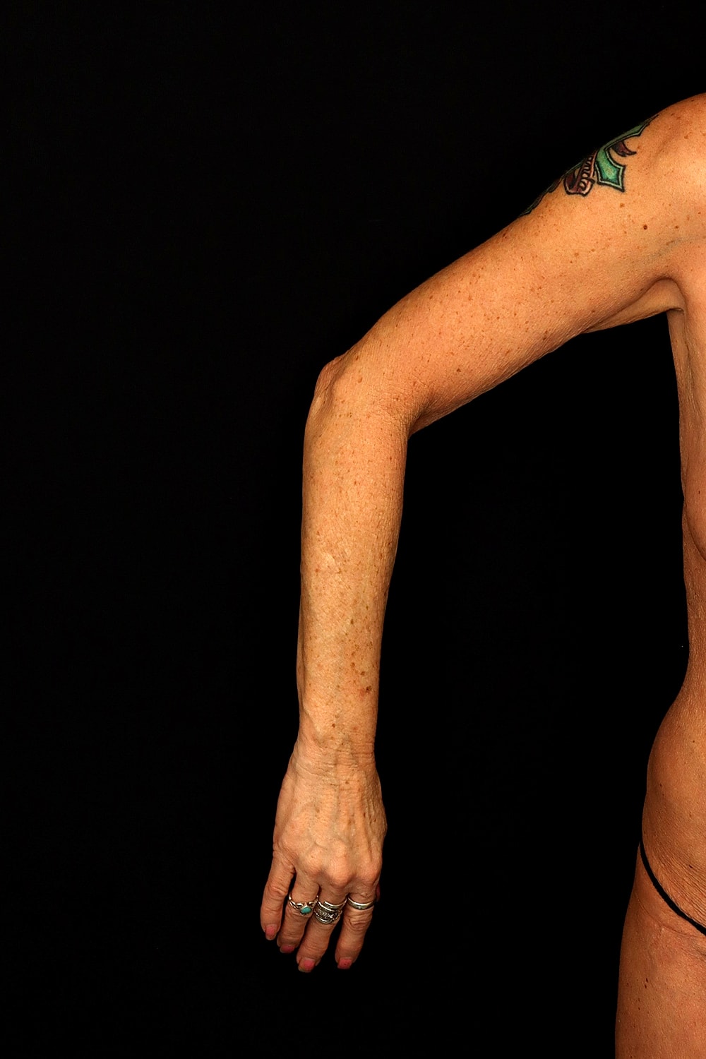 Brachioplasty | Arm Lift Before & After