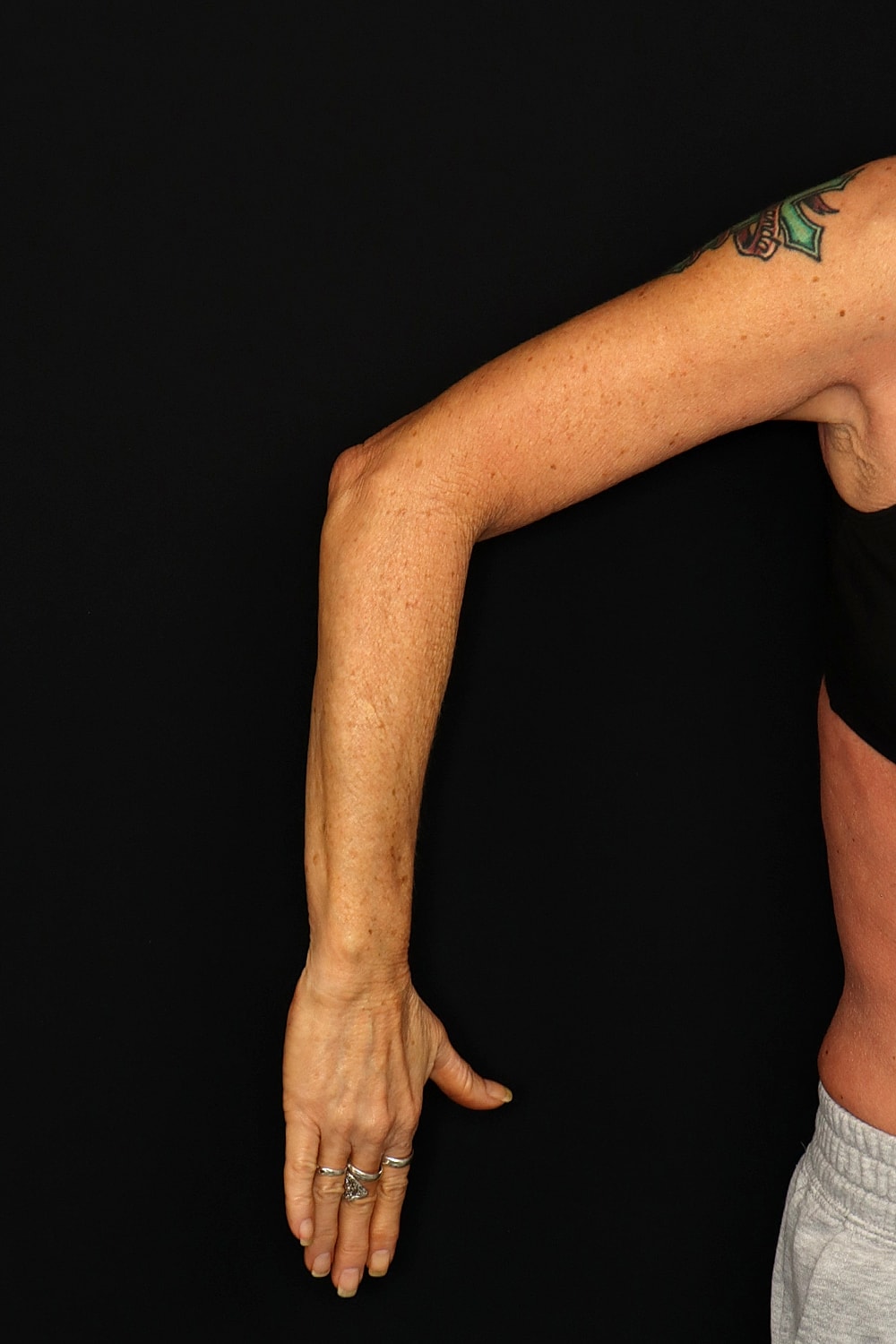 Brachioplasty | Arm Lift Before & After