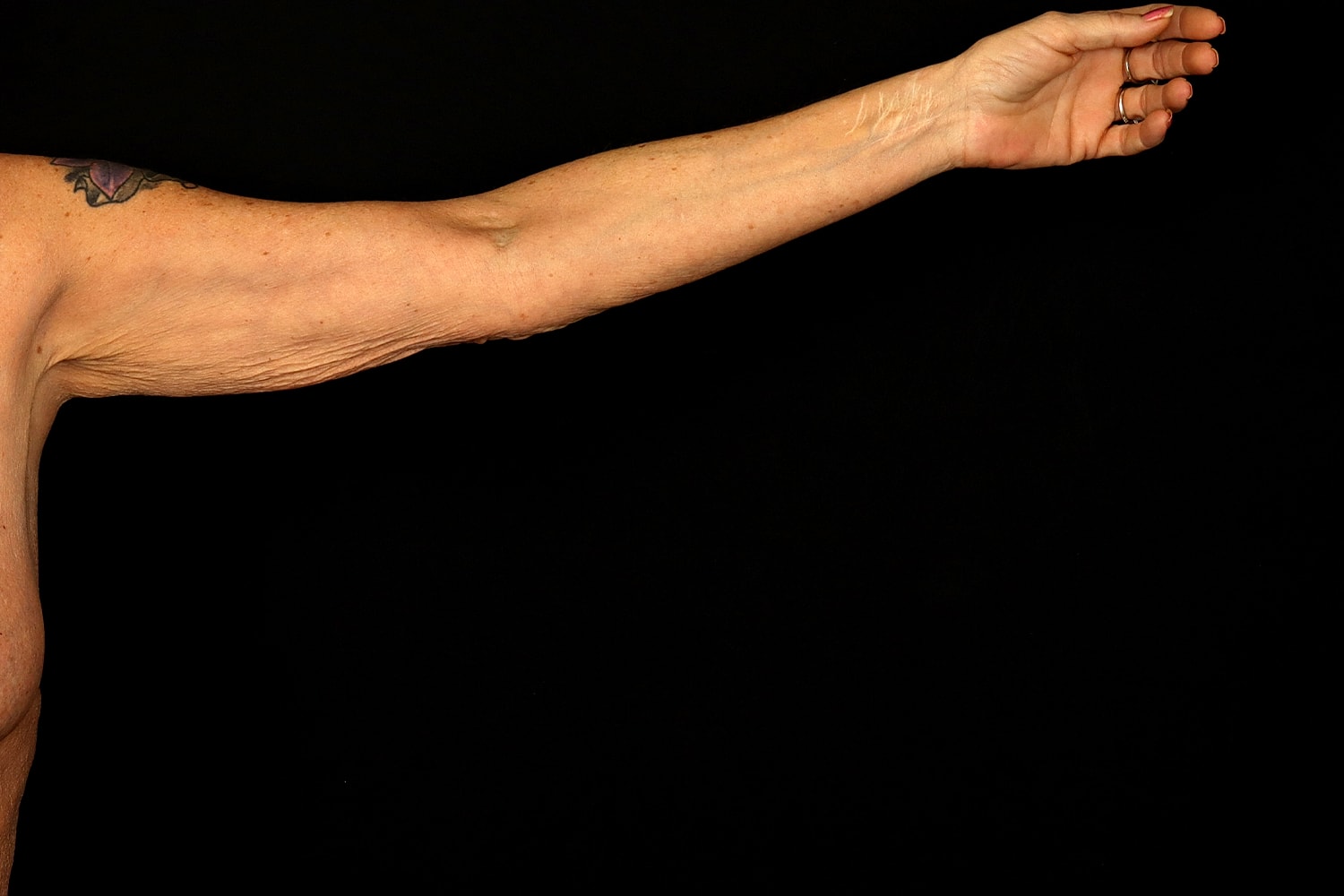 Brachioplasty | Arm Lift Before & After
