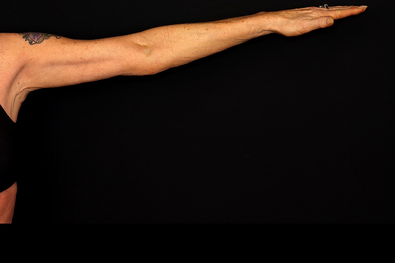 Brachioplasty | Arm Lift Before & After