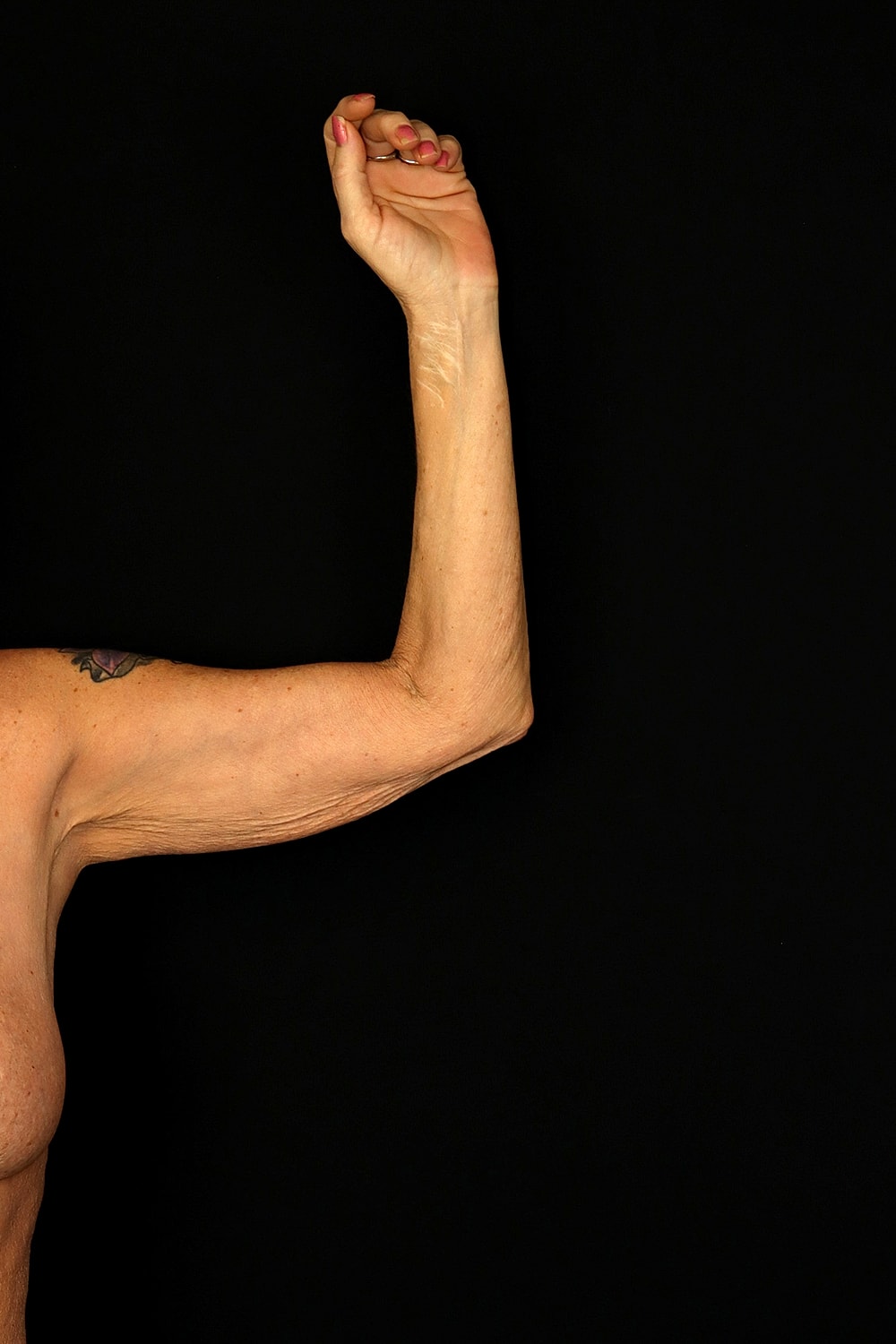 Brachioplasty | Arm Lift Before & After