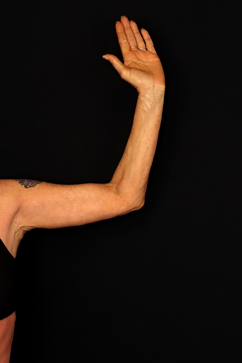 Brachioplasty | Arm Lift Before & After