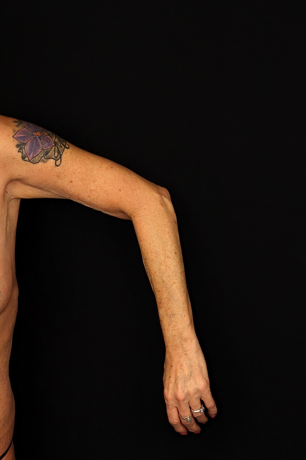 Brachioplasty | Arm Lift Before & After