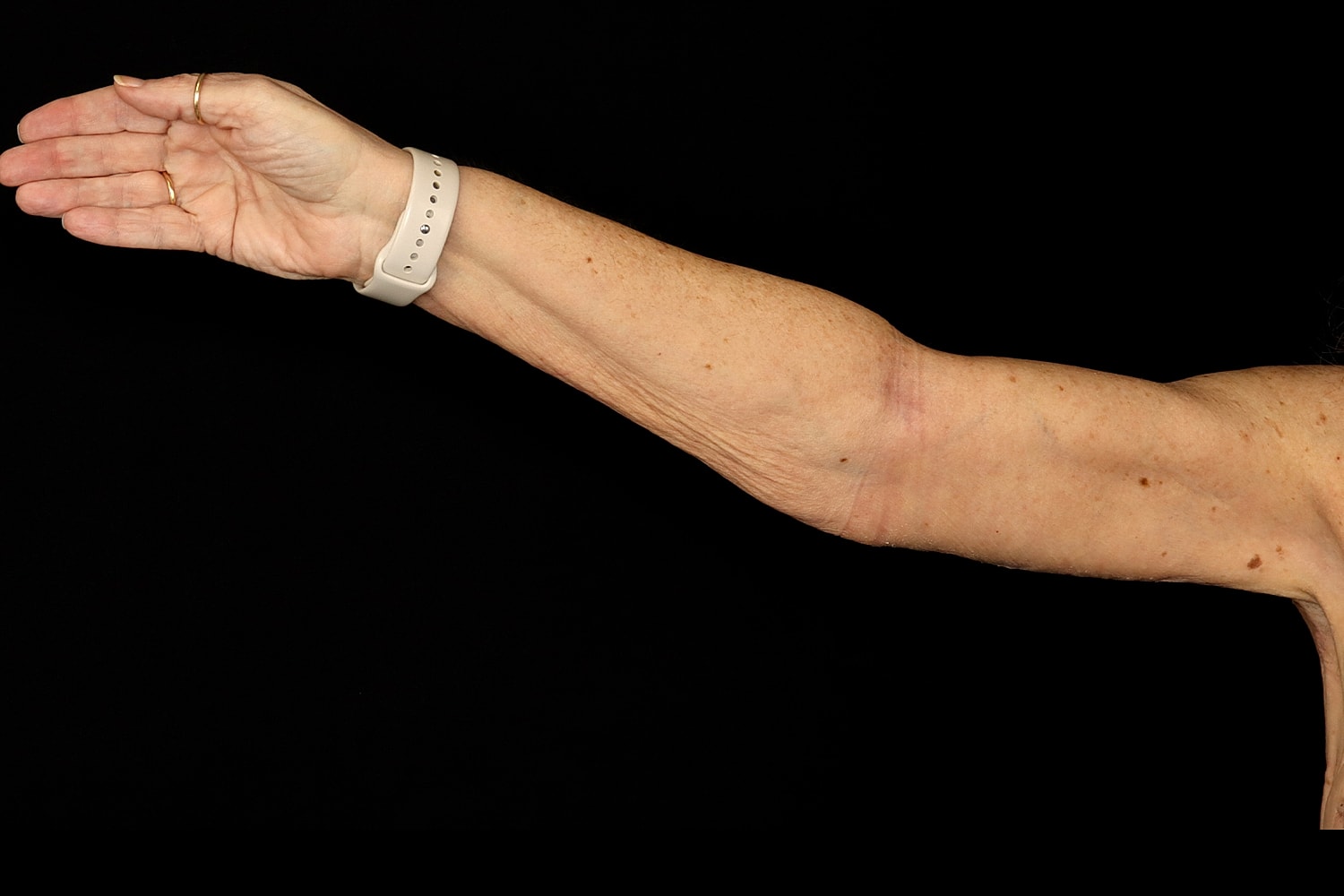 Brachioplasty | Arm Lift Before & After