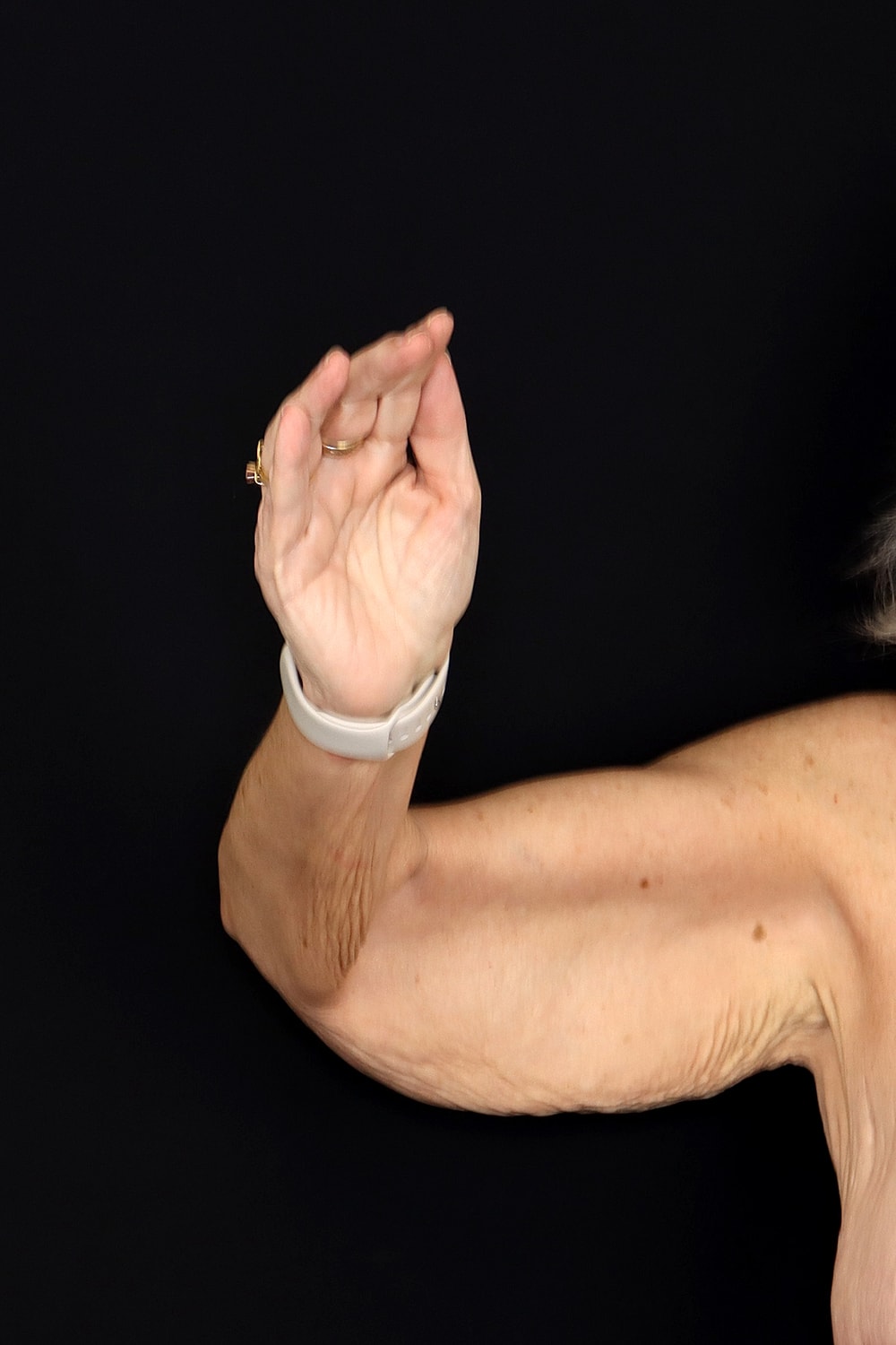Brachioplasty | Arm Lift Before & After