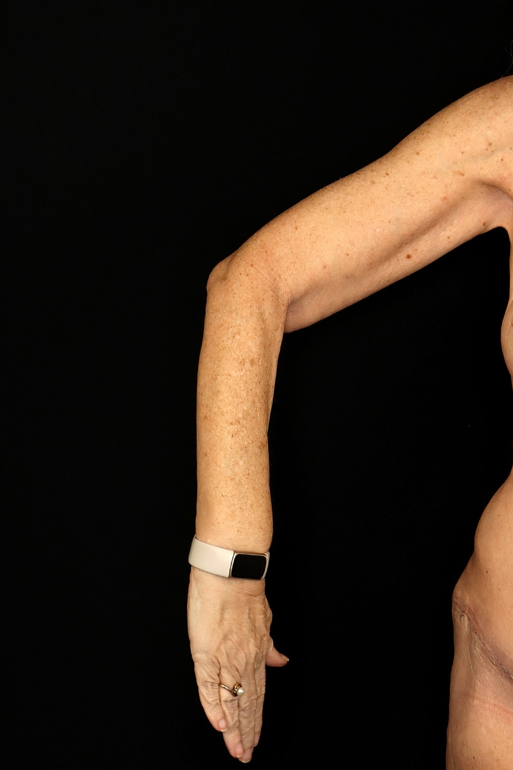 Brachioplasty | Arm Lift Before & After
