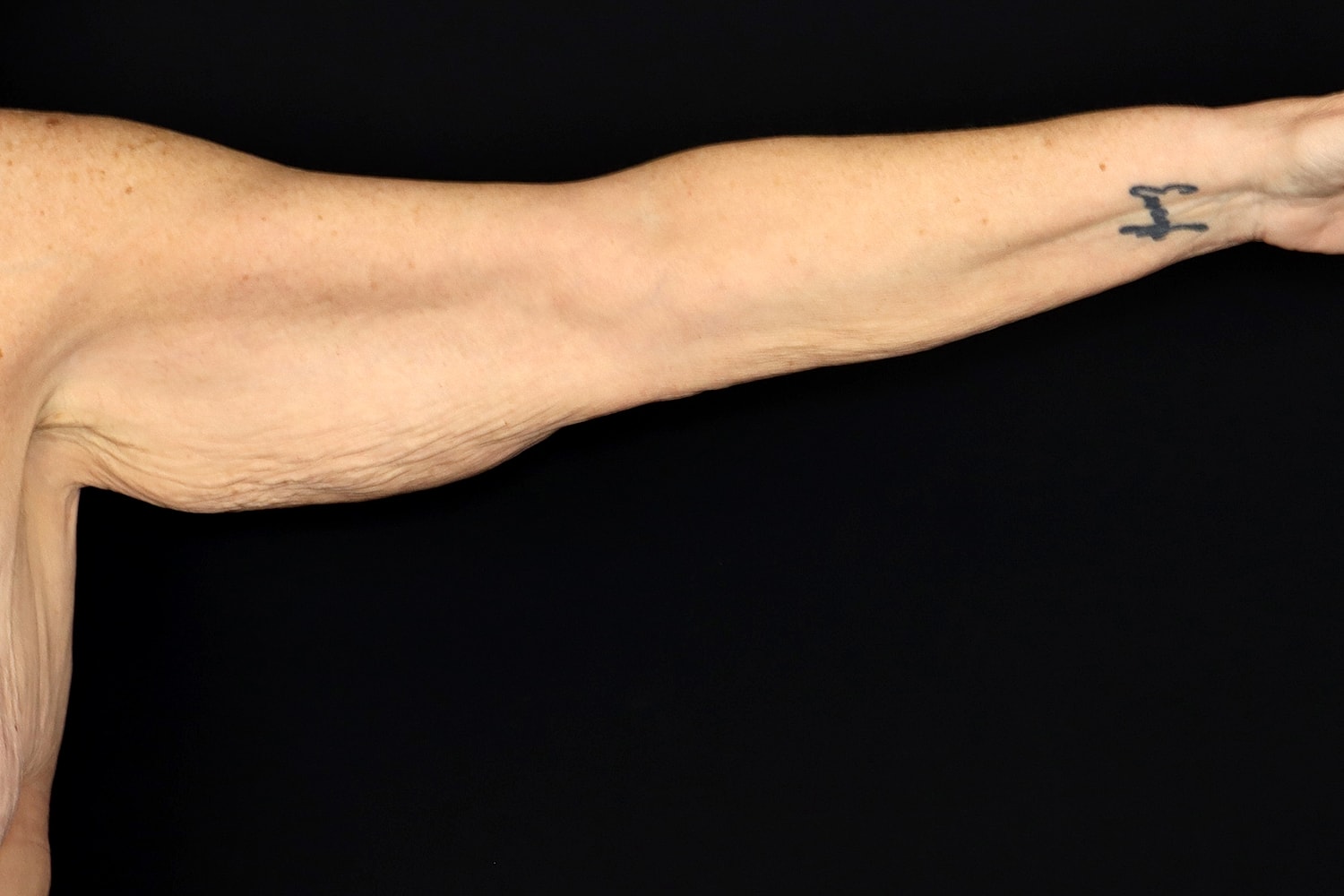 Brachioplasty | Arm Lift Before & After